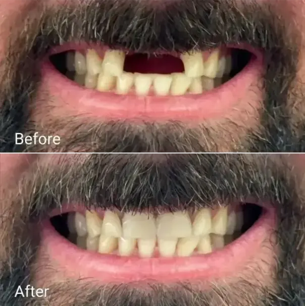 denture repair Gold Coast partial denture before after result