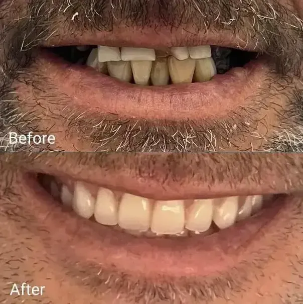 broken denture Gold Coast fixed denture repair before after
