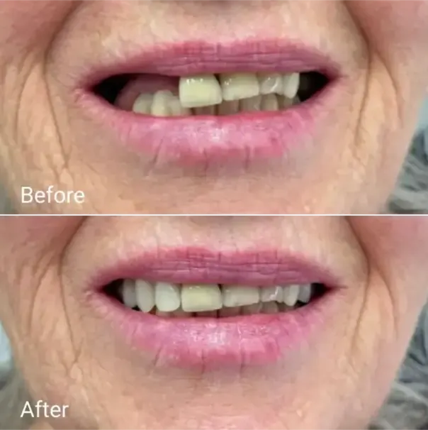 cracked denture repair Gold Coast before and after fix result