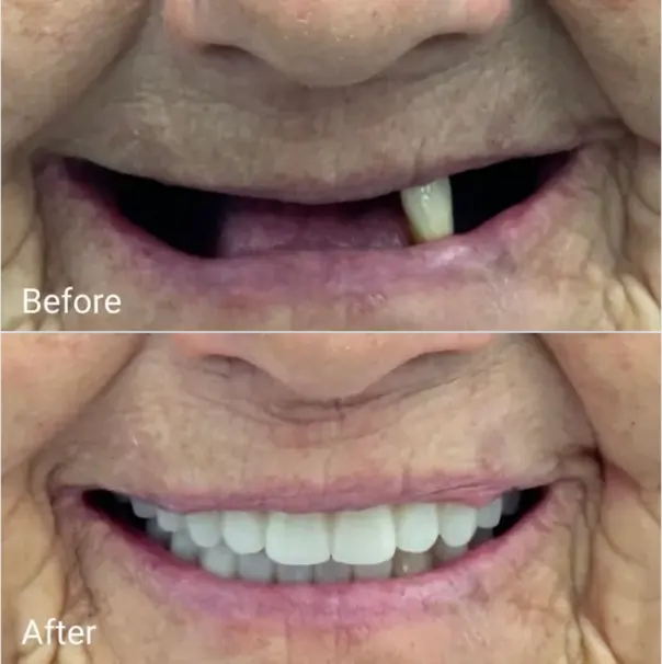 fix broken denture Gold Coast denture repair result